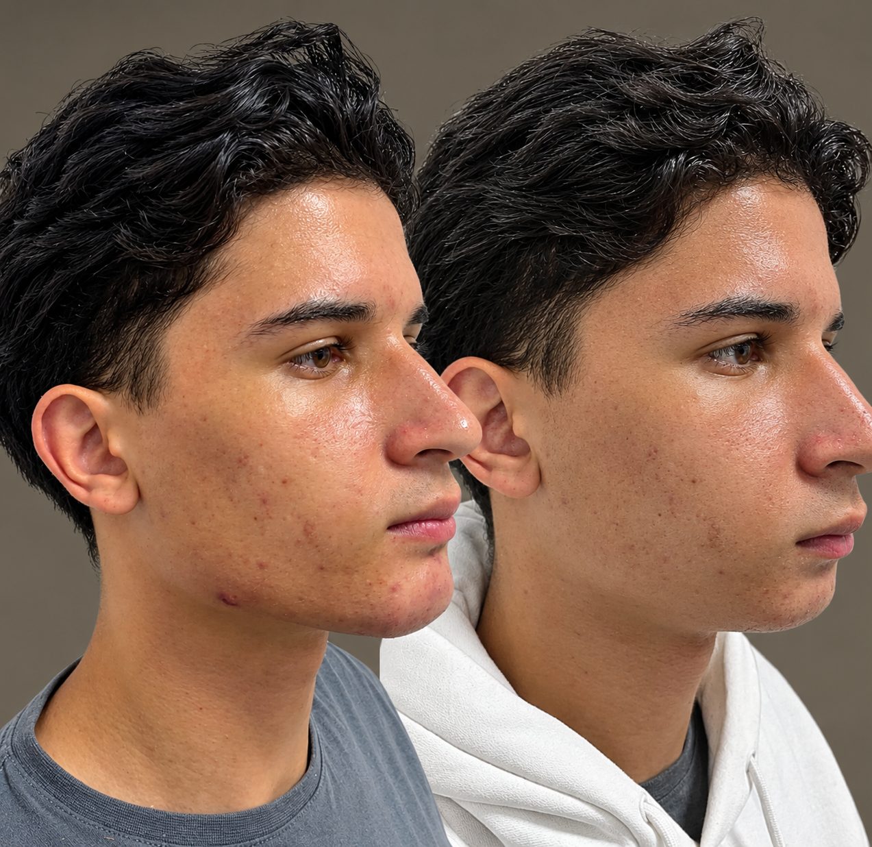 Antes e depois de harmonização do terço inferior com o Método Ângulo de Ouro
