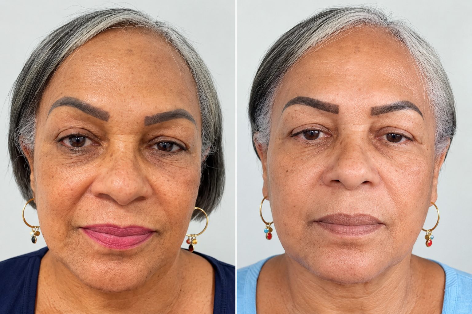 Antes e depois de tratamento com laser