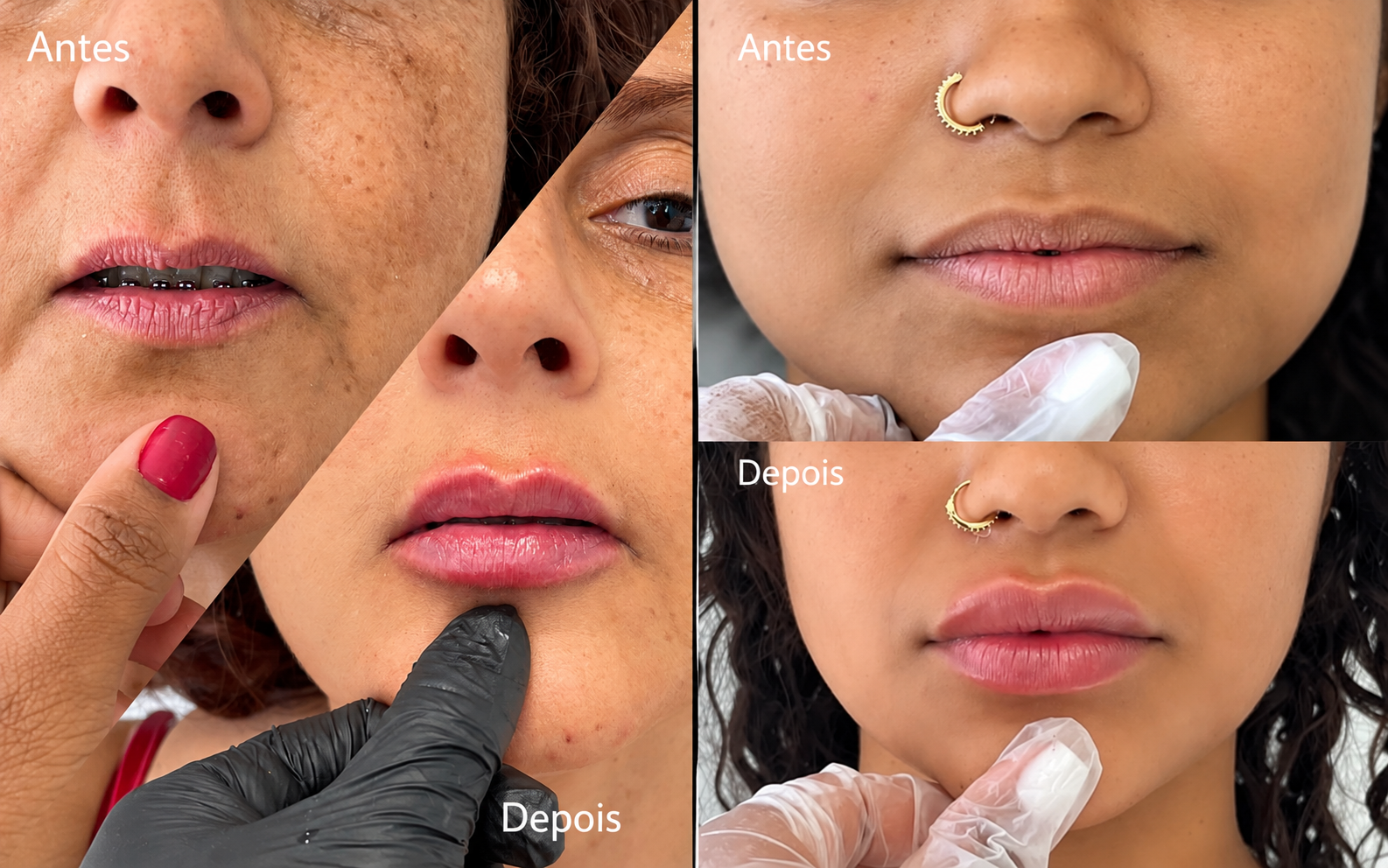 Antes e depois de preenchimento labial