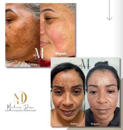 Antes e depois de tratamento de manchas