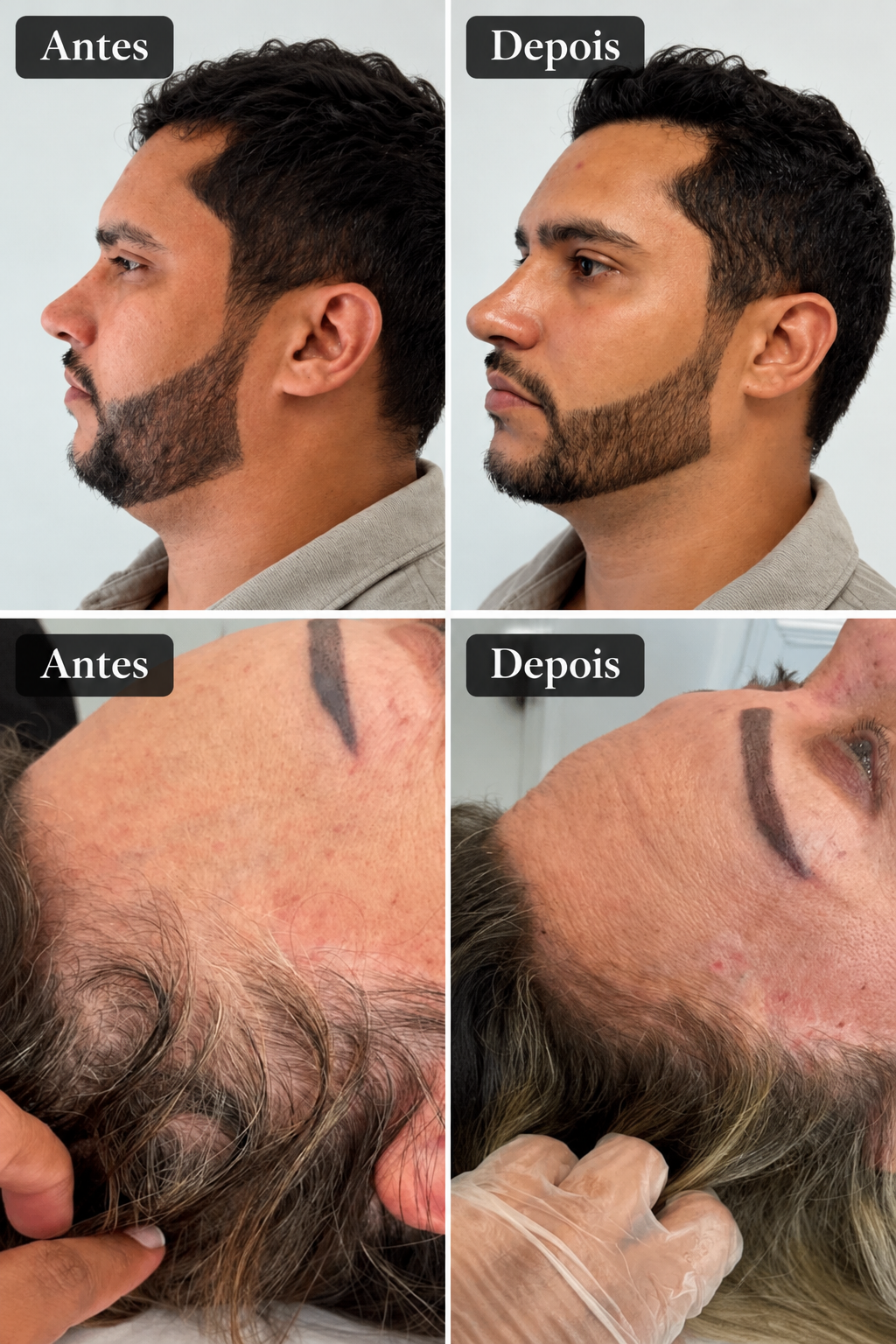 Antes e depois de preenchimento de mandíbula