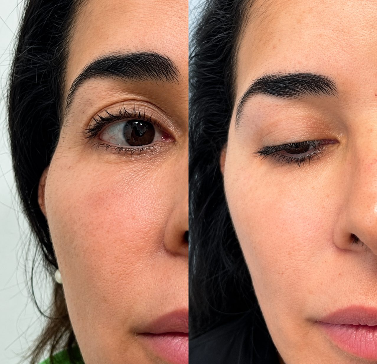 Antes e depois de preenchimento de têmpora