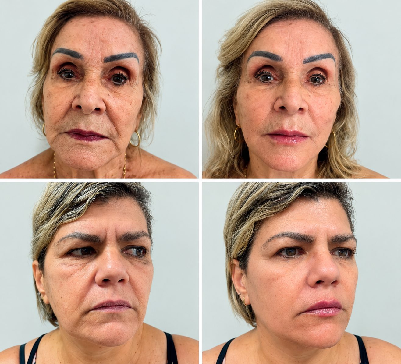 Antes e depois de harmonização facial